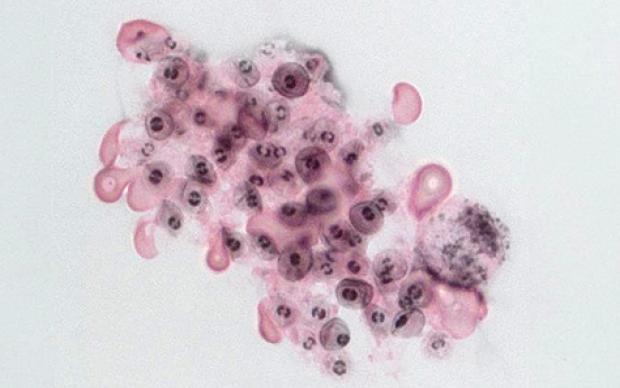 Image of the Pneumocystis fungus 