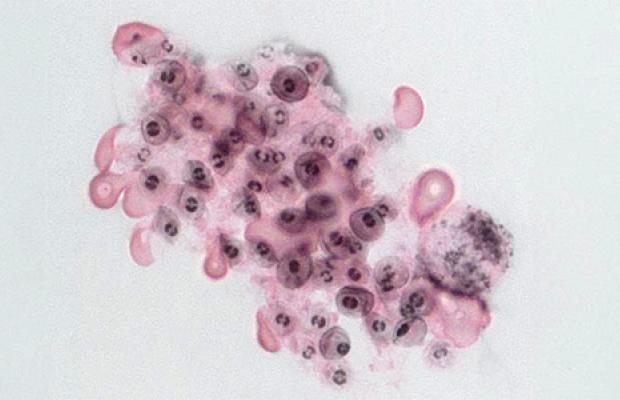 Image of the Pneumocystis fungus 